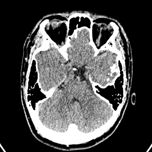 File:Cerebral arteriovenous malformation (Radiopaedia 37182-39012 Axial non-contrast 14).jpg