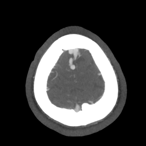 File:Cerebral arteriovenous malformation (Radiopaedia 39259-41505 AX CEREBRAL CTA 53).png