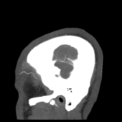 File:Cerebral arteriovenous malformation (Radiopaedia 39259-41505 Sagittal 56).png
