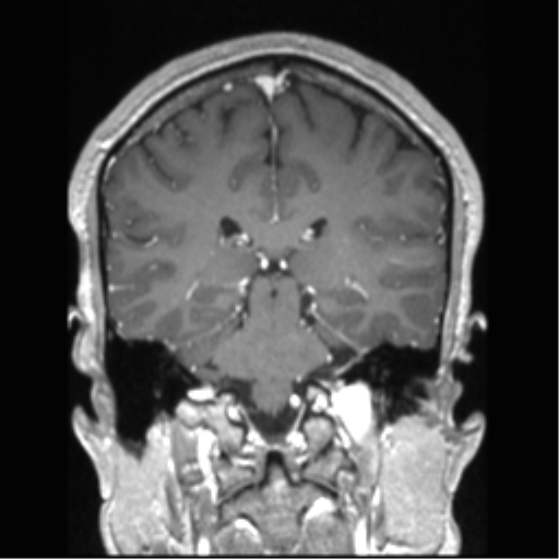 Cerebral arteriovenous malformation (Radiopaedia 39259-41506 Coronal T1 C+ 40).png