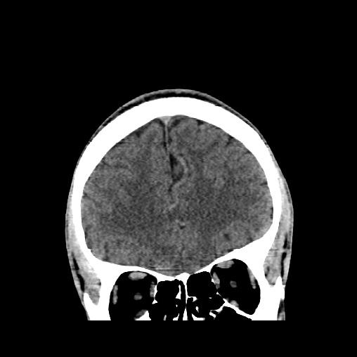 Cerebral arteriovenous malformation (Radiopaedia 61964-70028 Coronal non-contrast 16).jpg