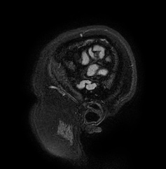 Cerebral arteriovenous malformation (Radiopaedia 74411-85654 Sagittal FLAIR 5).jpg