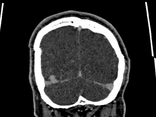 Cerebral arteriovenous malformation (Radiopaedia 78188-90746 Coronal C+ delayed 111).jpg