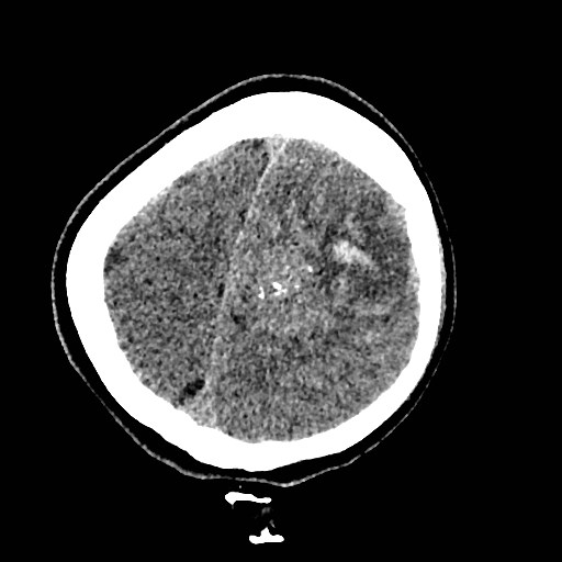 Cerebral arteriovenous malformation (Radiopaedia 79677-92887 Axial non-contrast 44).jpg
