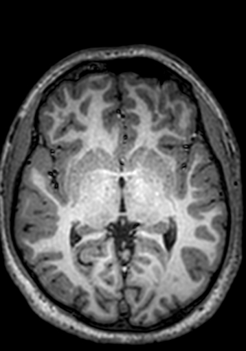 Cerebral arteriovenous malformation at posterior body of corpus callosum (Radiopaedia 74111-84925 Axial T1 159).jpg
