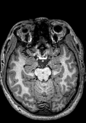 Cerebral arteriovenous malformation at posterior body of corpus callosum (Radiopaedia 74111-84925 Axial T1 196).jpg