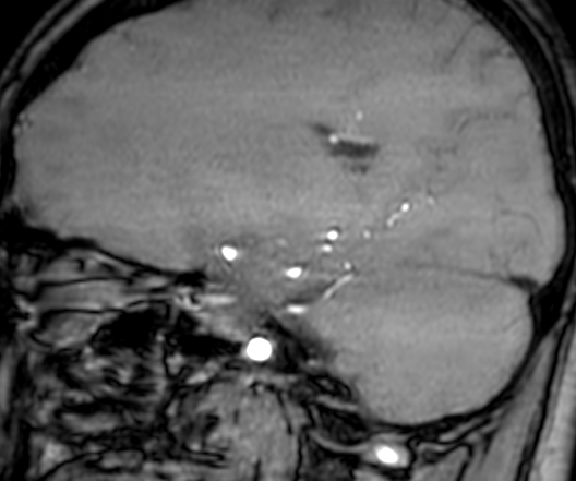 Cerebral arteriovenous malformation at posterior body of corpus callosum (Radiopaedia 74111-84925 J 143).jpg