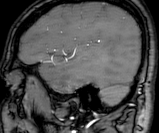 Cerebral arteriovenous malformation at posterior body of corpus callosum (Radiopaedia 74111-84925 J 60).jpg