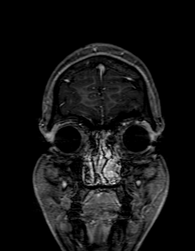 Cerebral arteriovenous malformation at posterior body of corpus callosum (Radiopaedia 74111-84925 K 23).jpg