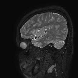Cerebral arteriovenous malformation at posterior body of corpus callosum (Radiopaedia 74111-84925 Sagittal T2 108).jpg