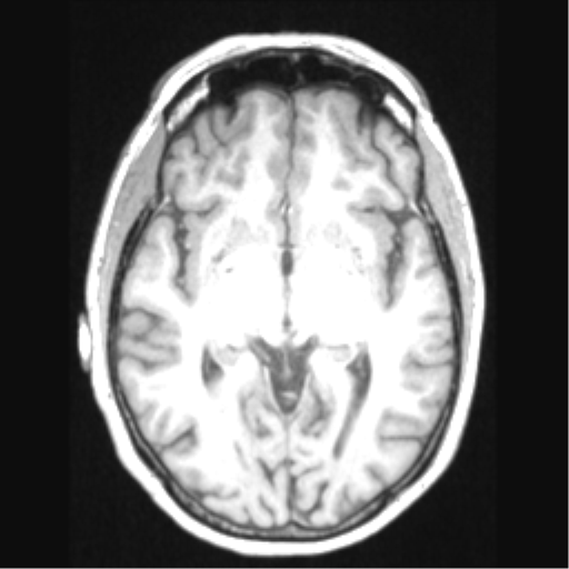 Cerebral arteriovenous malformation with hemorrhage (Radiopaedia 34422-35737 Axial T1 36).png