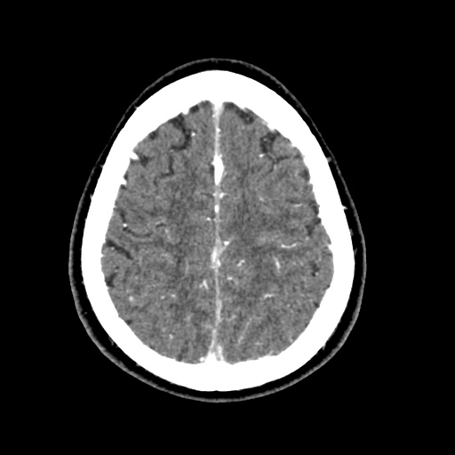 Cerebral arteriovenous malformation with lobar hemorrhage (Radiopaedia 35598-57216 A 50).jpg