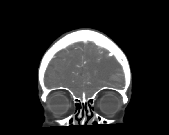 File:Cerebral arteriovenous malformation with lobar hemorrhage (Radiopaedia 44725-48511 A 11).png