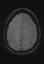 File:Cerebral cavernoma and development venous anomaly (Radiopaedia 37603-39482 Axial SWI 31).png