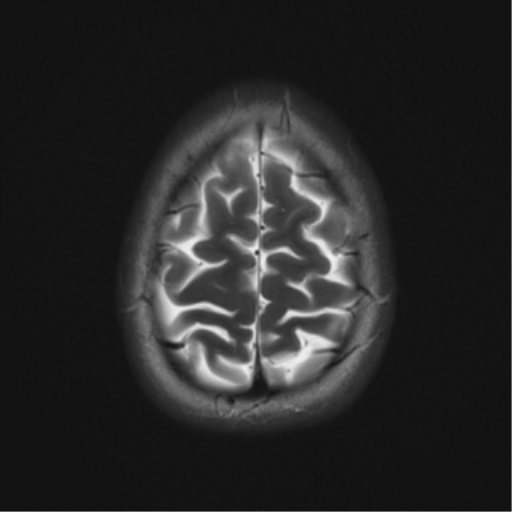 File:Cerebral cavernoma and development venous anomaly (Radiopaedia 37603-39482 Axial T2 20).png