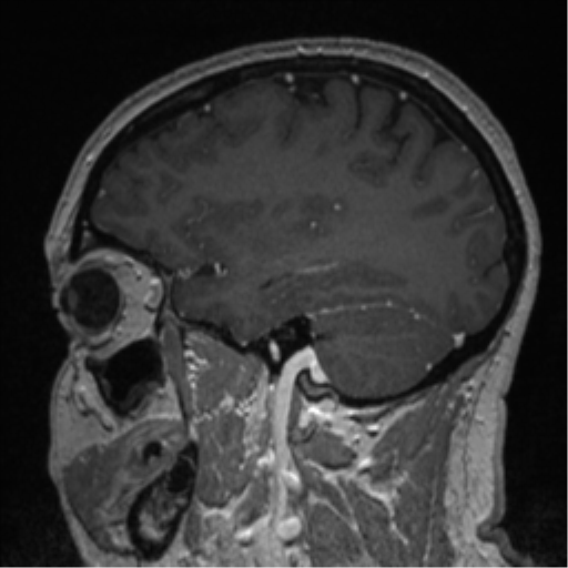 Cerebral cavernoma and development venous anomaly (Radiopaedia 37603-39482 Sagittal T1 C+ 30).png