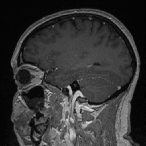 Cerebral cavernoma and development venous anomaly (Radiopaedia 37603-39482 Sagittal T1 C+ 32).png