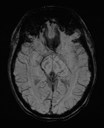 Cerebral cavernous venous malformation (Radiopaedia 70008-80021 Axial SWI 31).jpg