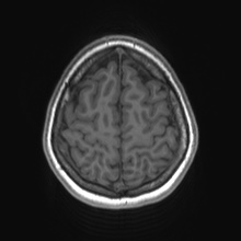 File:Cerebral cavernous venous malformation (Radiopaedia 70008-80021 Axial T1 75).jpg