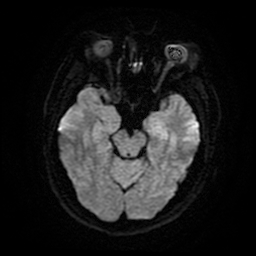 Cerebral cavernous venous malformation (Zabramski type II) (Radiopaedia 85511-101198 Axial DWI 13).jpg