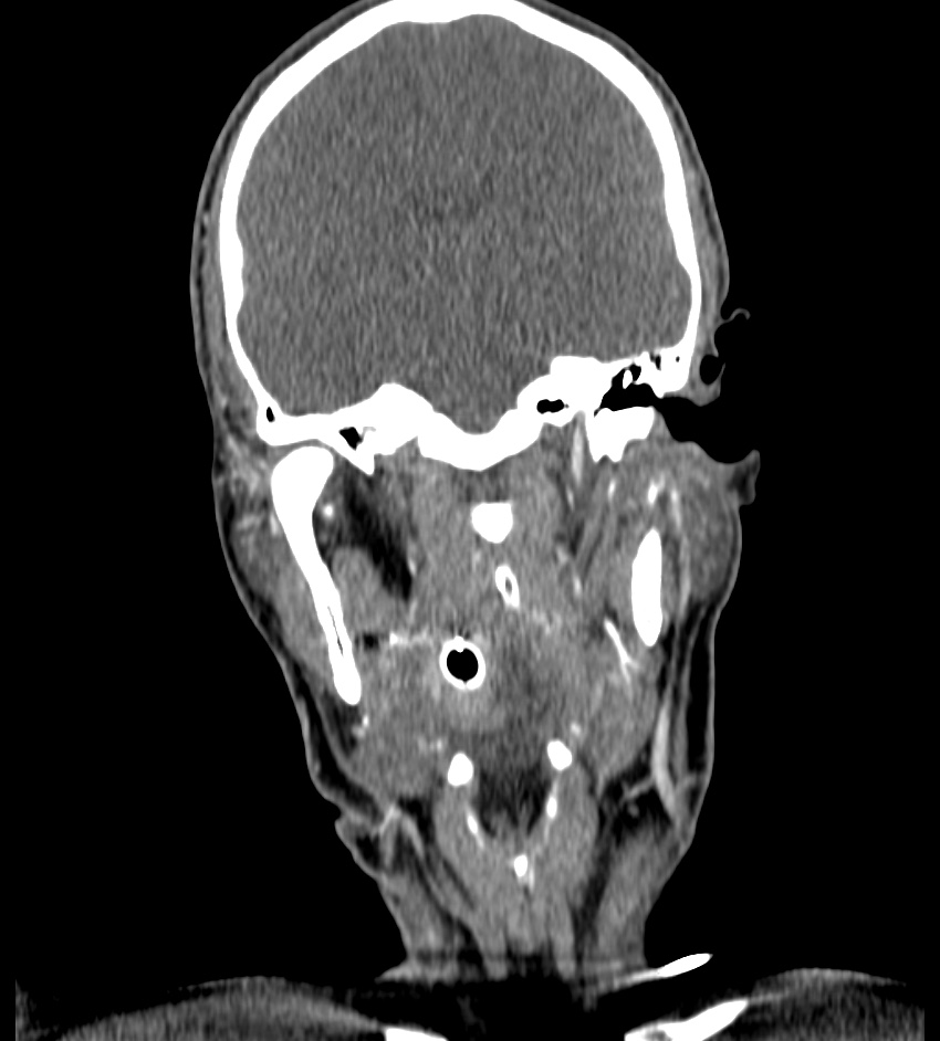 Cerebral edema in an overdose patient (Radiopaedia 72005-82539 B 54).jpg
