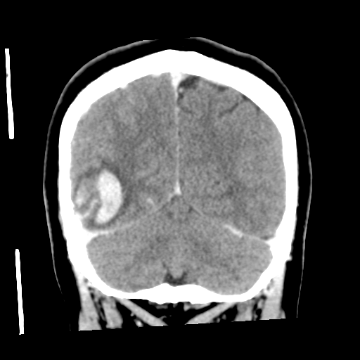 File:Cerebral hemorrhage secondary to arteriovenous malformation (Radiopaedia 33497-34561 C 51).png