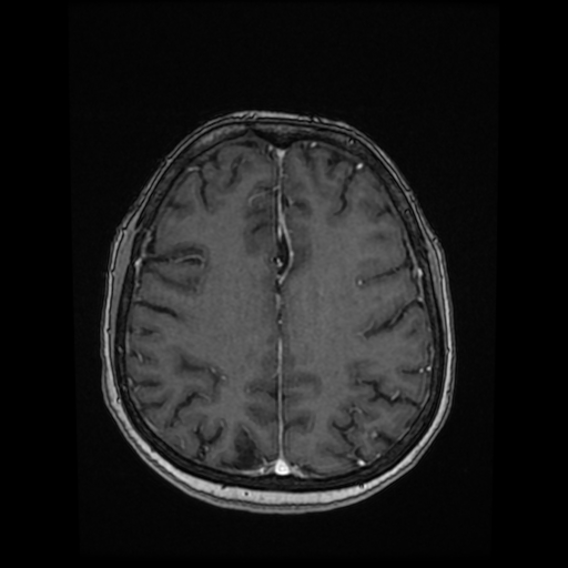 Cerebral metastases - melanoma (Radiopaedia 80972-94522 Axial T1 C+ 67).jpg