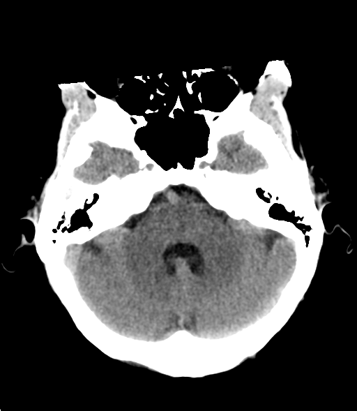 File:Cerebral metastasis (Radiopaedia 46744-51247 Axial non-contrast 8).png
