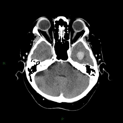 File:Cerebral metastasis from renal cell carcinoma (Radiopaedia 82306-96375 Axial C+ delayed 9).jpg