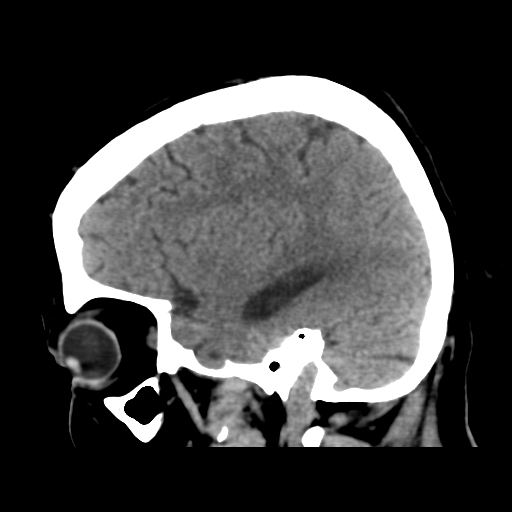 Cerebral metastasis to basal ganglia (Radiopaedia 81568-95412 E 44).png