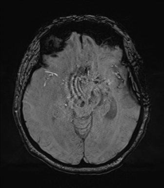 Cerebral metastasis to basal ganglia (Radiopaedia 81568-95413 Axial SWI 35).png
