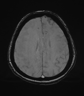 Cerebral metastasis to basal ganglia (Radiopaedia 81568-95413 Axial SWI magnitude 64).png
