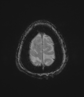 File:Cerebral metastasis to basal ganglia (Radiopaedia 81568-95413 Axial SWI magnitude 82).png