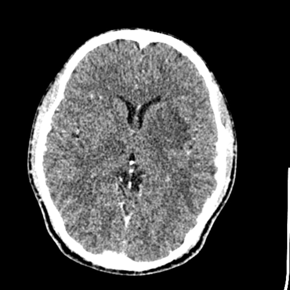 File:Cerebral toxoplasmosis (Radiopaedia 53993-60131 Axial C+ delayed 36).jpg