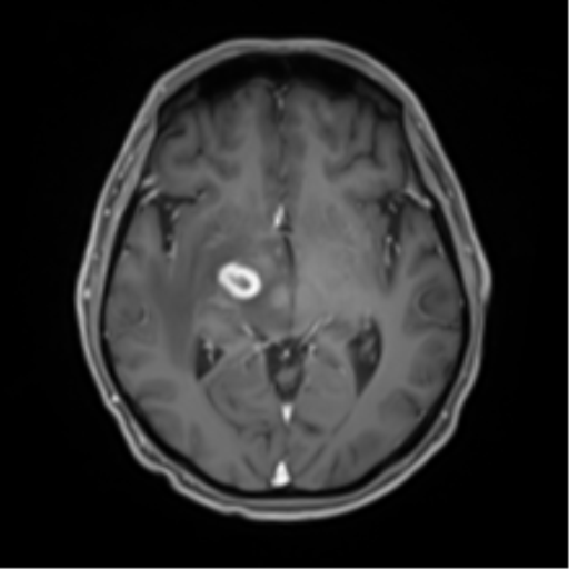 Cerebral toxoplasmosis (Radiopaedia 54575-60804 Axial T1 C+ 26).png