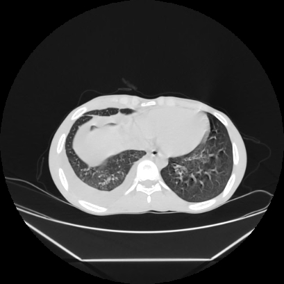 Cerebral tuberculoma (Radiopaedia 80829-94318 Axial lung window 141).jpg