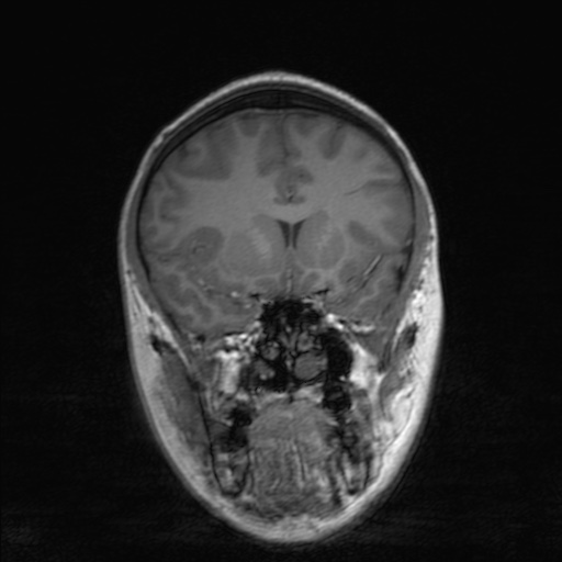 Cerebral tuberculosis with dural sinus invasion (Radiopaedia 60353-68090 Coronal T1 71).jpg