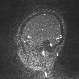 Cerebral tuberculosis with dural sinus invasion (Radiopaedia 60353-68090 Sagittal MRV 129).jpg