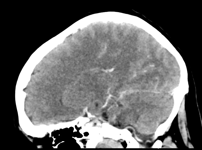 Cerebral venous hemorrhagic infarction (Radiopaedia 57576-64538 Sagittal C+ 23).png