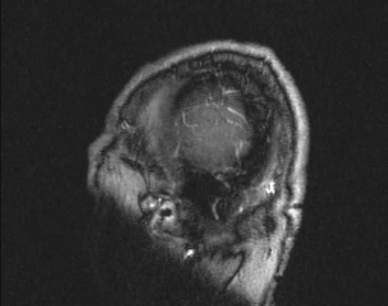 Cerebral venous infarction (Radiopaedia 65166-74176 Sagittal TOF 7).jpg