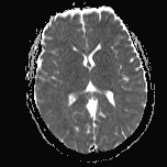 File:Cerebral venous infarction - hemorrhagic (Radiopaedia 81625-95505 Axial ADC 12).jpg
