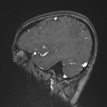 Cerebral venous infarction - hemorrhagic (Radiopaedia 81625-95505 Sagittal MRV 59).jpg