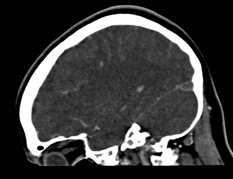 Cerebral venous sinus thrombosis (Radiopaedia 59224-66646 Sagittal C+ delayed 44).jpg