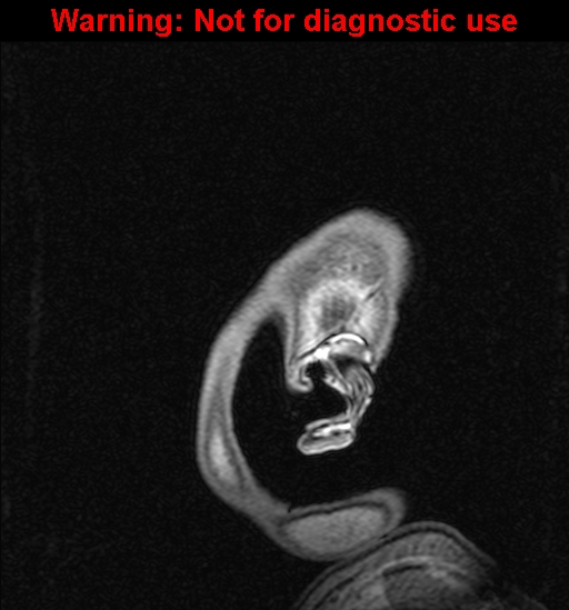 File:Cerebral venous thrombosis (Radiopaedia 37224-39208 Sagittal T1 C+ 154).jpg