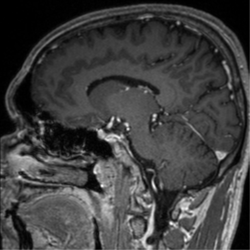Cerebral venous thrombosis (Radiopaedia 38392-40469 Sagittal T1 C+ 40).png