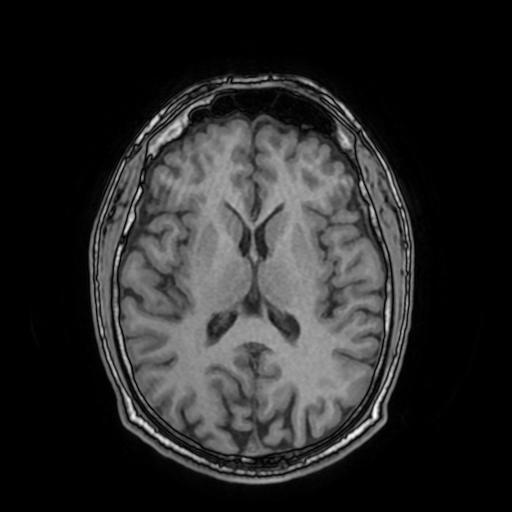File:Cerebral venous thrombosis with secondary intracranial hypertension (Radiopaedia 89842-106957 Axial T1 102).jpg