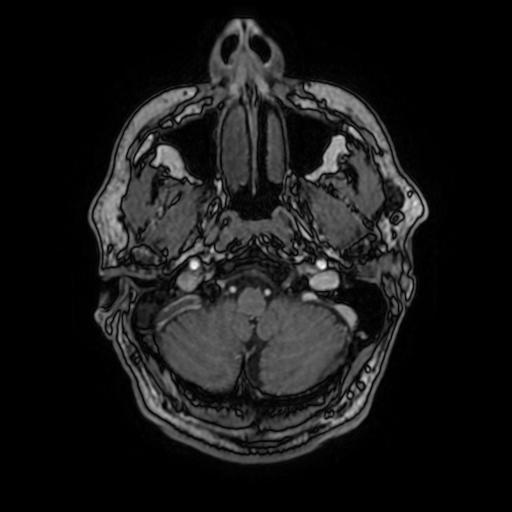 File:Cerebral venous thrombosis with secondary intracranial hypertension (Radiopaedia 89842-106957 Axial T1 C+ 40).jpg
