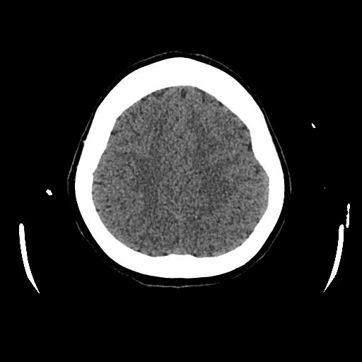 Cerebral venous thrombosis with venous hemorrhagic infarct (Radiopaedia 90354-107660 Axial non-contrast 39).jpg