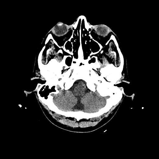 File:Cerebral venous thrombosis with venous hemorrhagic infarct (Radiopaedia 90354-107660 Axial non-contrast 9).jpg