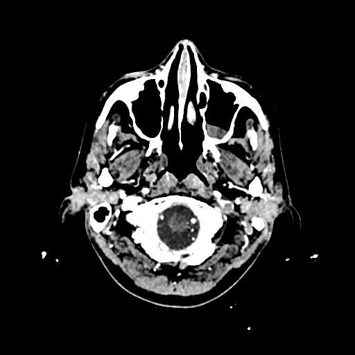 File:Cerebral venous thrombosis with venous hemorrhagic infarct (Radiopaedia 90354-107660 Axial with contrast 15).jpg